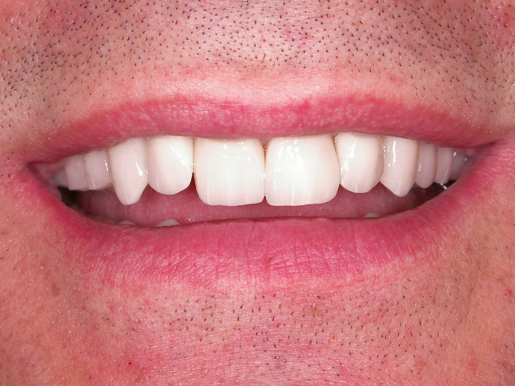 Komplettbehandlung mit Vollkeramik und einigen Implantaten